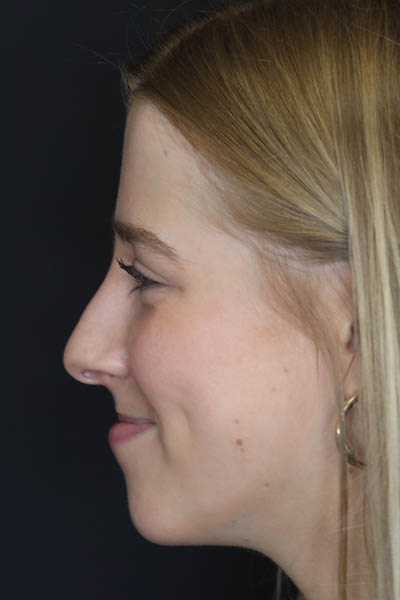 Rhinoplasty case #5794