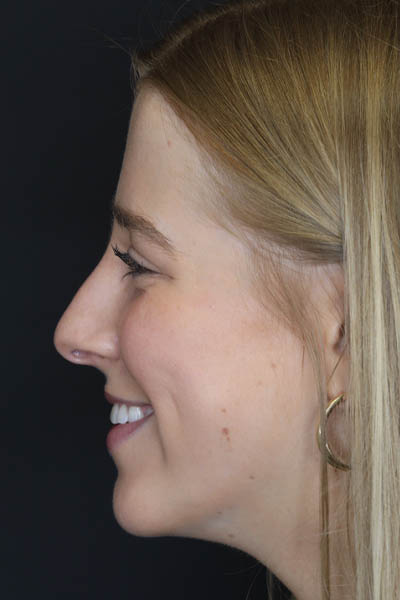 Rhinoplasty case #5794