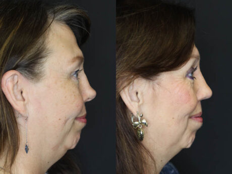 Revision Rhinoplasty case #6014