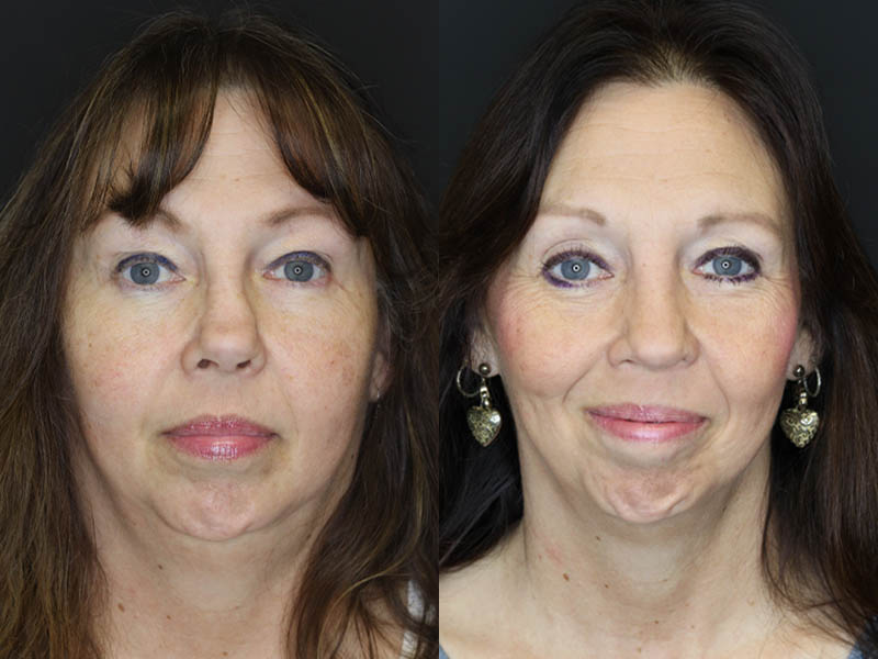 Revision Rhinoplasty case #6014