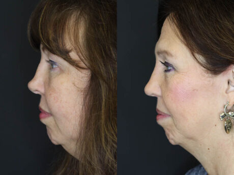 Revision Rhinoplasty case #6014