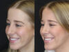 Rhinoplasty case #5794 slider thumbnail