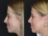 Rhinoplasty case #5794 slider thumbnail