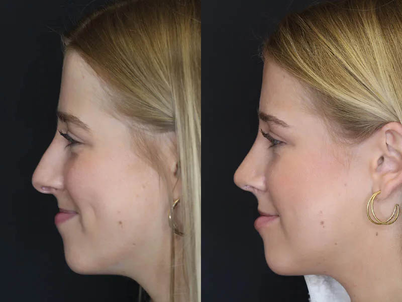 Rhinoplasty case #5794