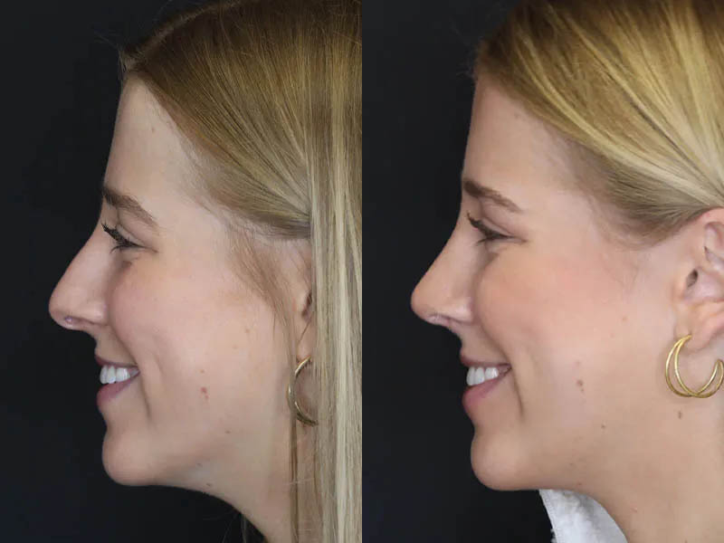 Rhinoplasty case #5794