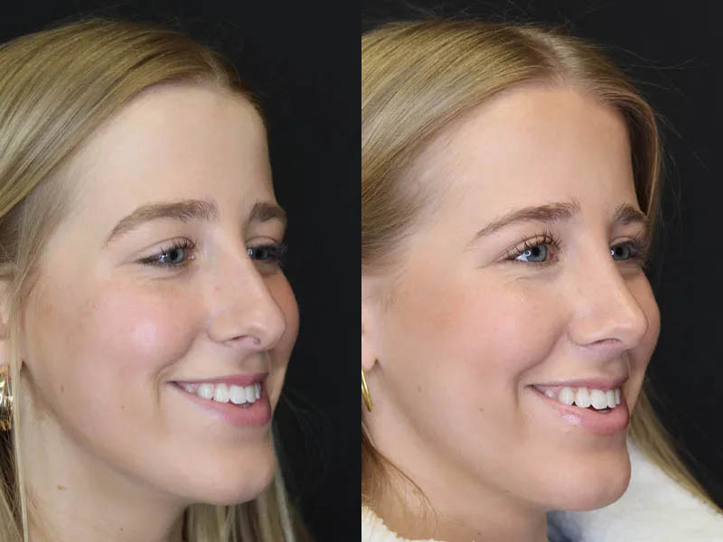 Rhinoplasty case #5794