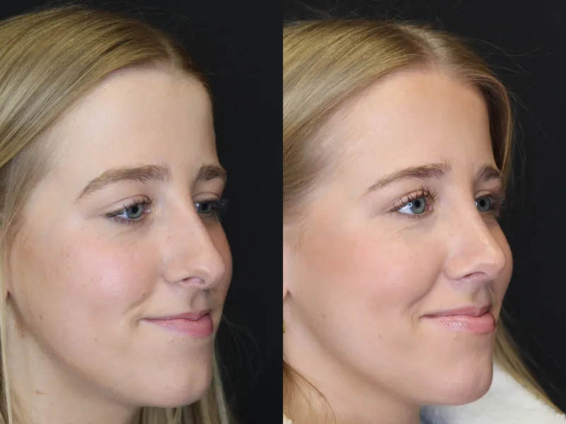Rhinoplasty case #5794