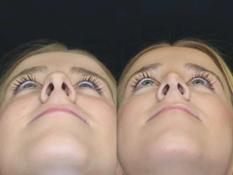 Rhinoplasty case #5794