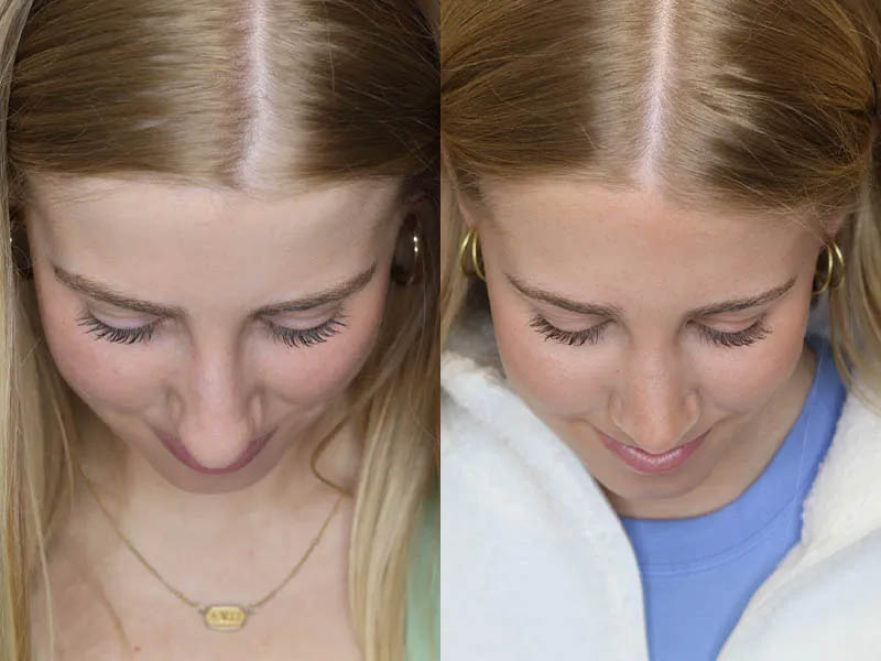 Rhinoplasty case #5794