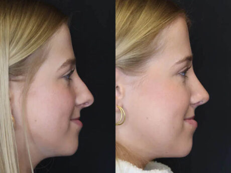 Rhinoplasty case #5794