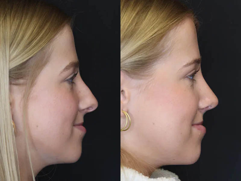 Rhinoplasty case #5794