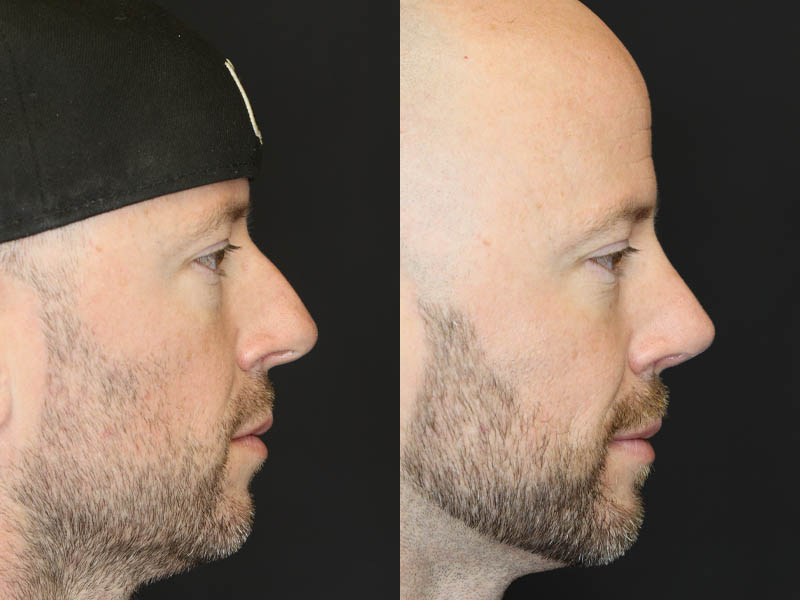 Rhinoplasty case #5783