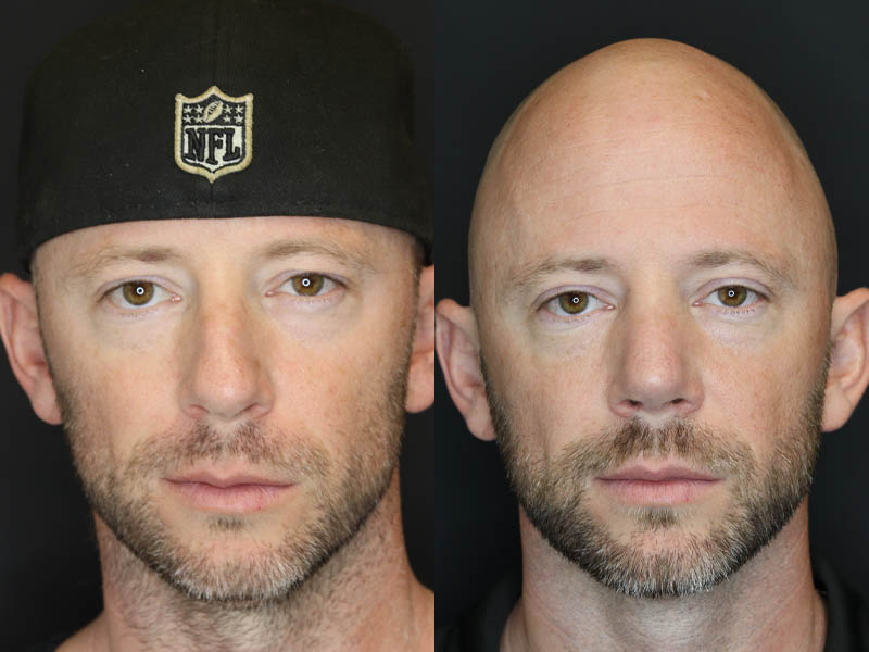 Rhinoplasty case #5783