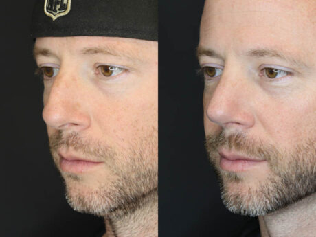 Rhinoplasty case #5783