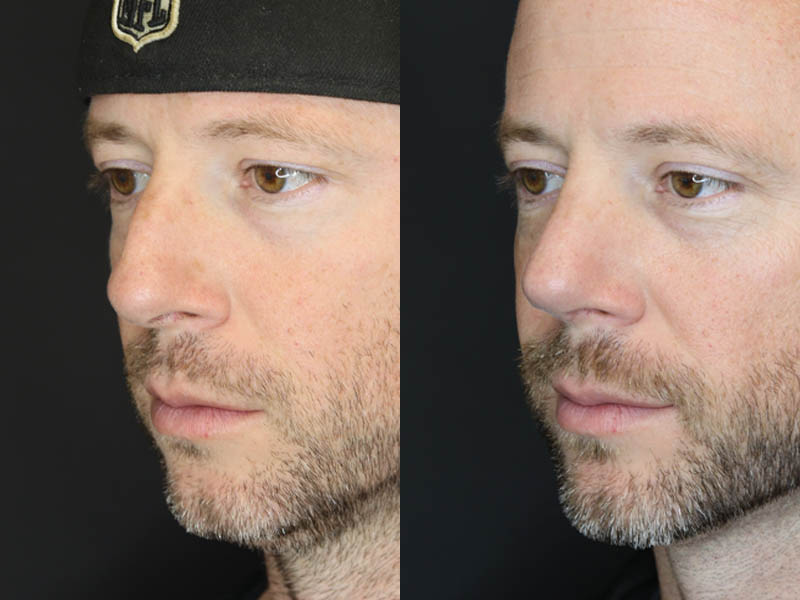 Rhinoplasty case #5783