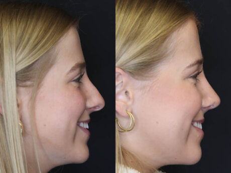 Rhinoplasty case #5794