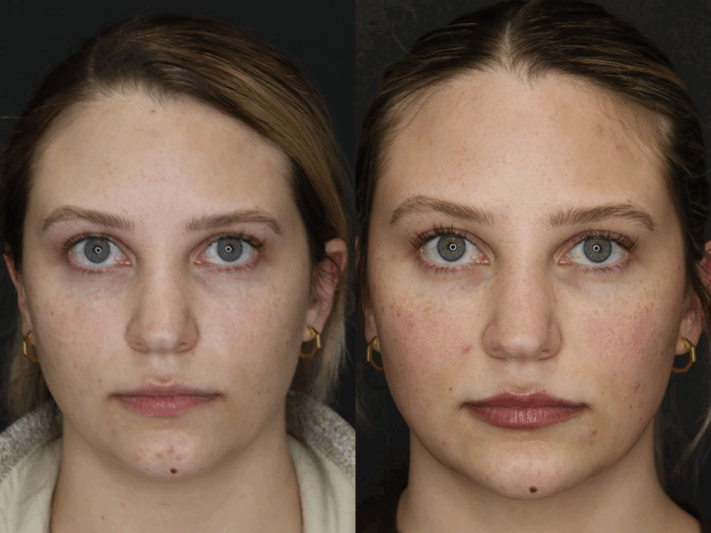 Liposuction case #5780