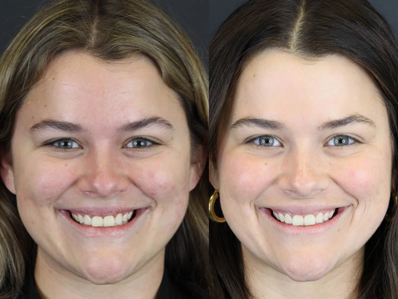 Skin Resurfacing case #5852