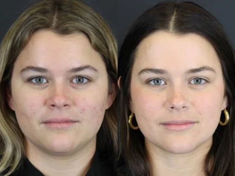 Skin Resurfacing case #5852