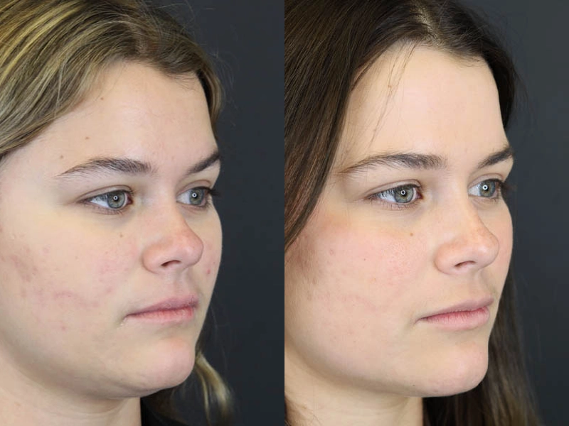 Skin Resurfacing case #5852