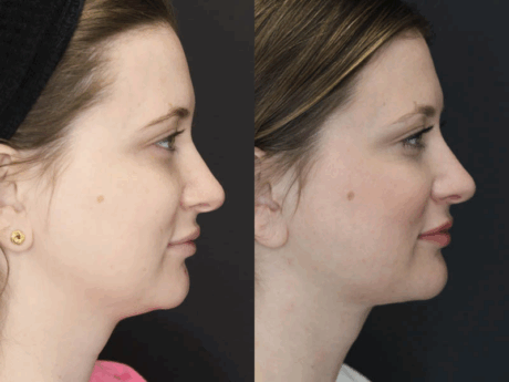 Liposuction case #5865