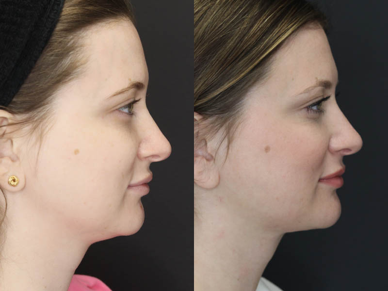Liposuction case #5865