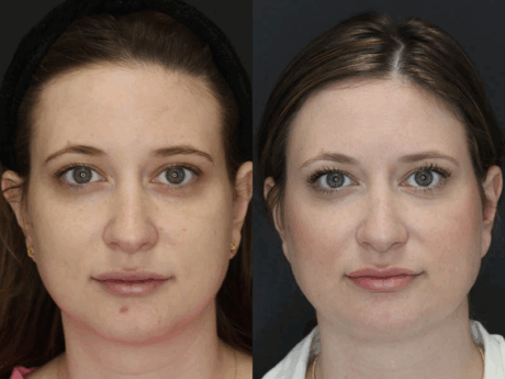 Liposuction case #5865