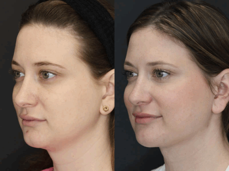 Liposuction case #5865