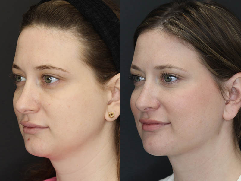 Liposuction case #5865