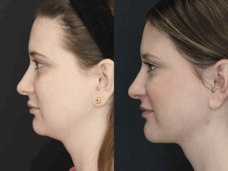 Liposuction case #5865