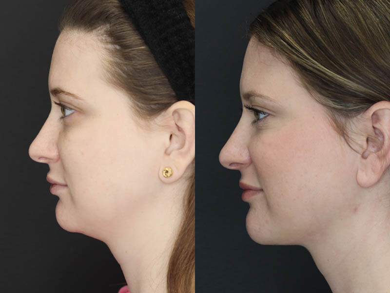 Liposuction case #5865