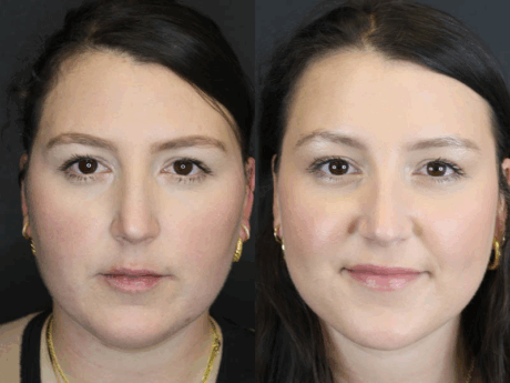 Liposuction case #5886