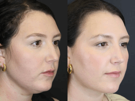 Liposuction case #5886