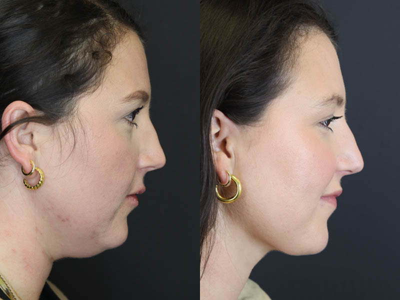 Liposuction case #5886