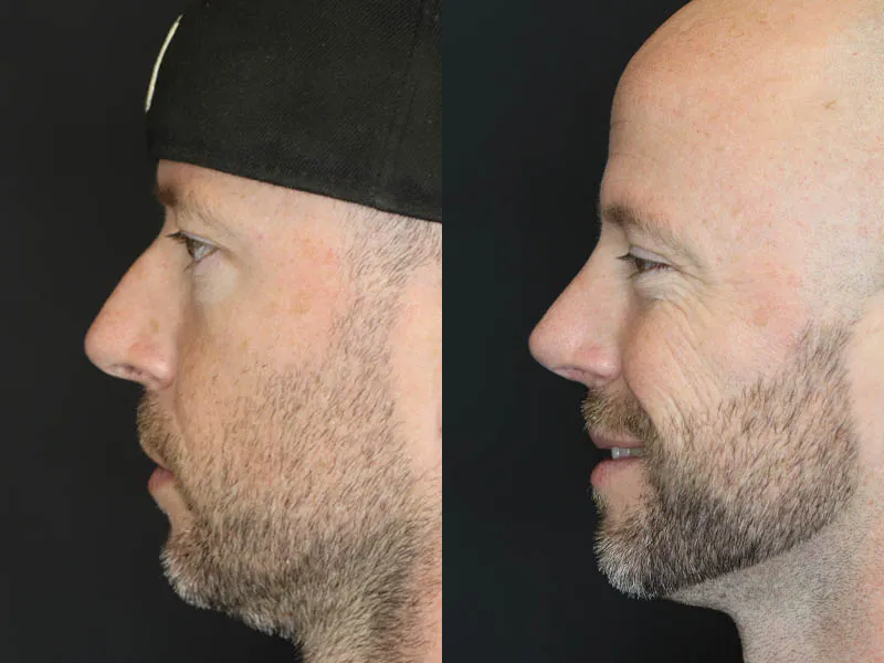 Rhinoplasty case #5783