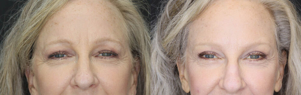 Blepharoplasty case #5714