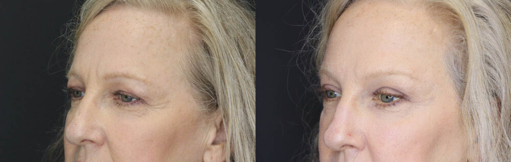 Blepharoplasty case #5714