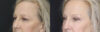 Blepharoplasty case #5714 slider thumbnail