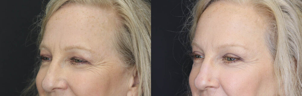 Blepharoplasty case #5714