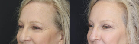 Blepharoplasty case #5714