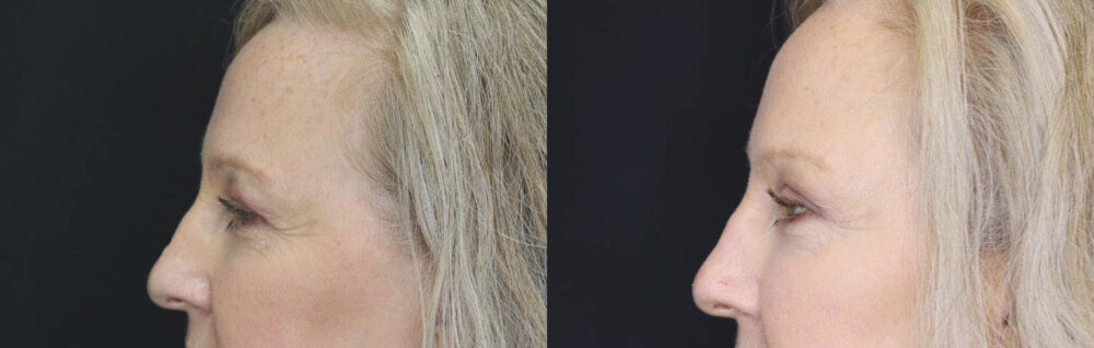 Blepharoplasty case #5714