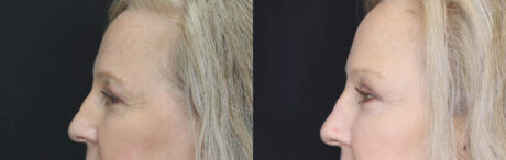 Blepharoplasty case #5714