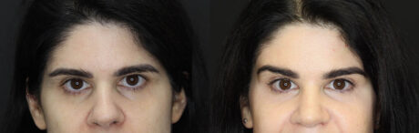 Brow Lift case #5745