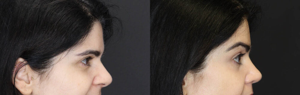 Brow Lift case #5745