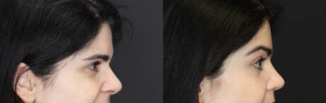 Brow Lift case #5745