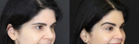 Brow Lift case #5745