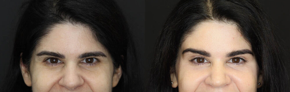 Brow Lift case #5745