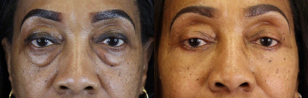 Blepharoplasty case #5732