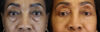 Blepharoplasty case #5732 slider thumbnail
