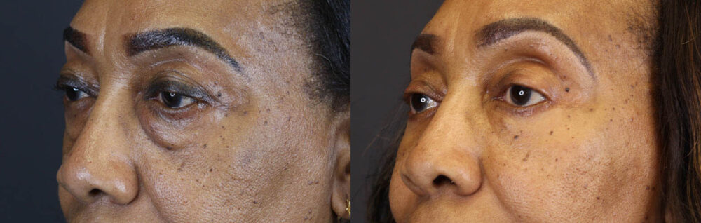 Blepharoplasty case #5732